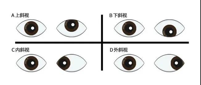 孩子斜视怎么办？